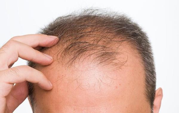 این عامل تشدیدکننده ریزش مو در مردان را بشناسید